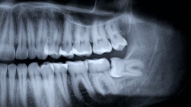 Wisdom tooth pain assessment in Singapore for patients experiencing discomfort at the back of the mouth