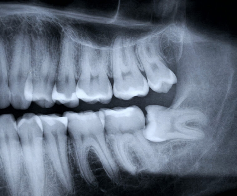 Wisdom tooth pain assessment in Singapore for patients experiencing discomfort at the back of the mouth