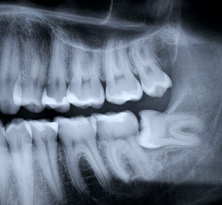 Wisdom tooth pain assessment in Singapore for patients experiencing discomfort at the back of the mouth