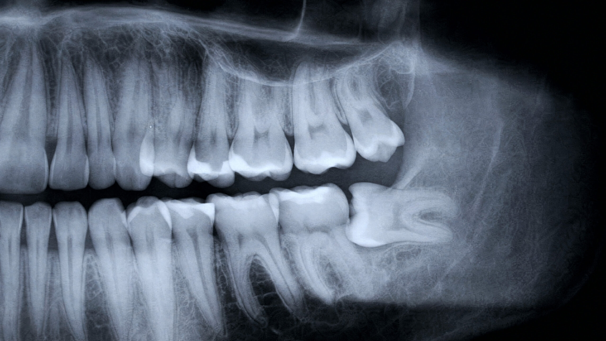 Wisdom tooth pain assessment in Singapore for patients experiencing discomfort at the back of the mouth