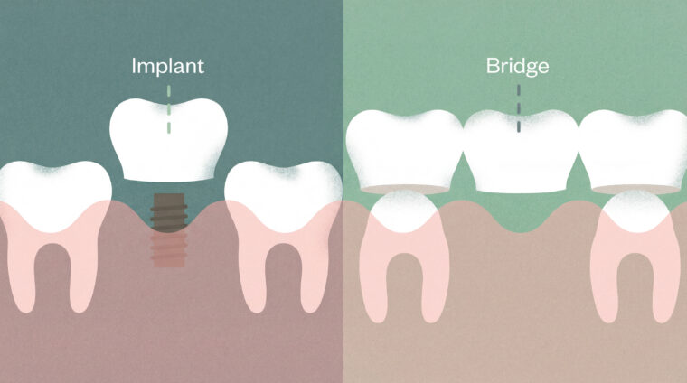 Dental Implant vs Bridge: Key Differences, Pros/Cons (Singapore)