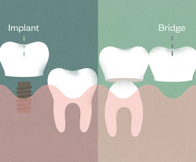 Dental Implant vs Bridge: Key Differences, Pros/Cons (Singapore)