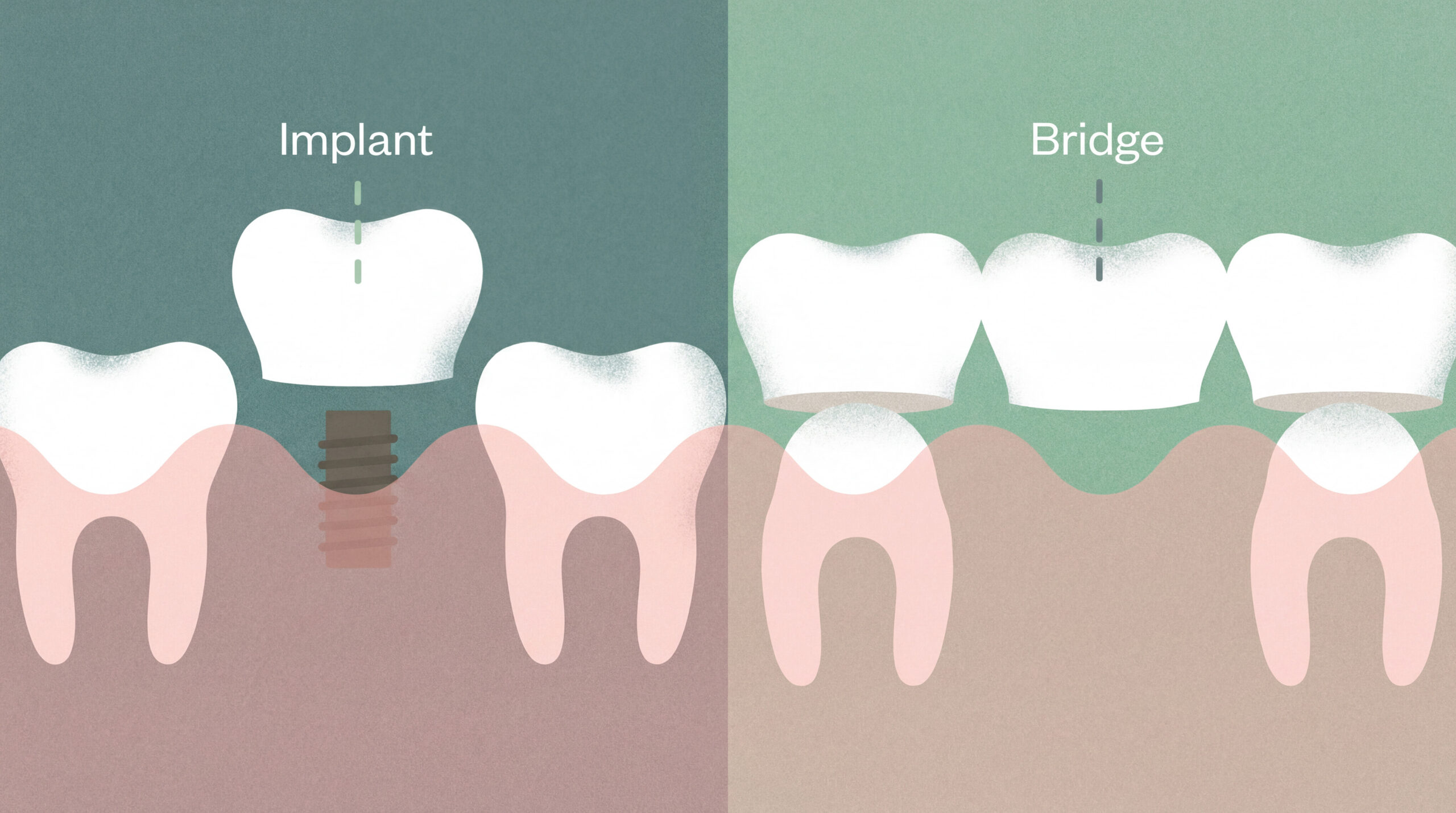 Dental Implant vs Bridge: Key Differences, Pros/Cons (Singapore)