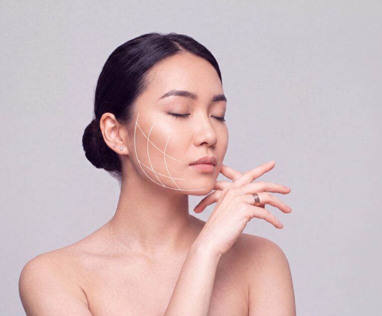 Woman with facial guide lines illustrating jaw alignment